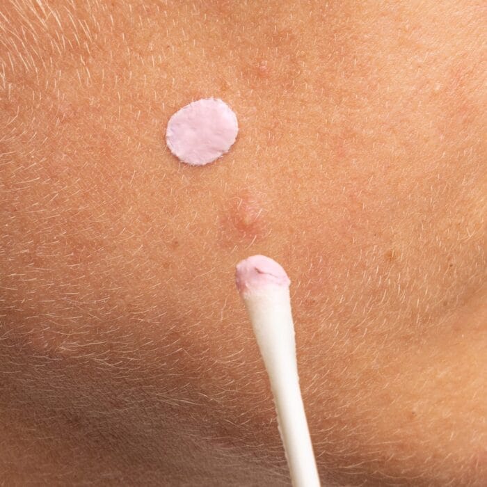 Blemish Pink Spot Mizon - Κορεάτικα Καλλυντικά